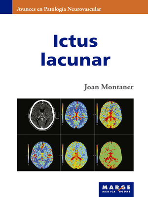 cover image of Ictus lacunar